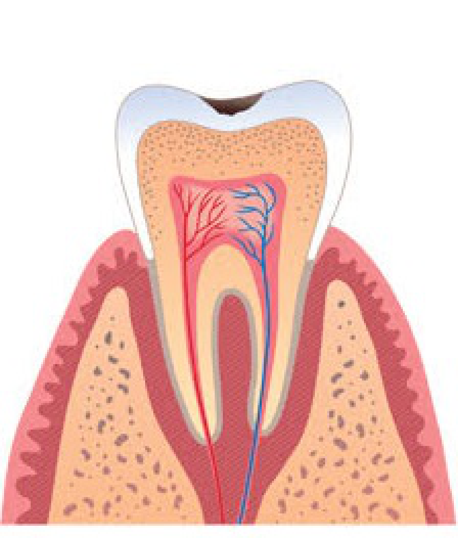 Поверхностный кариес