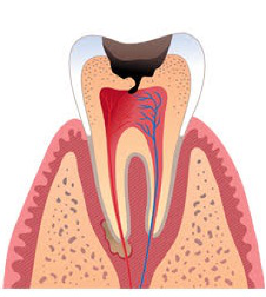 Периодонтит